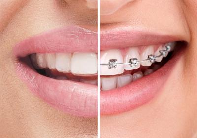 Braces & Aligners